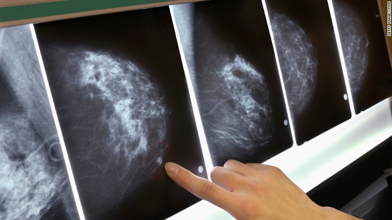 111018092923-mammogram-breast-cancer-x-ray-exlarge-169