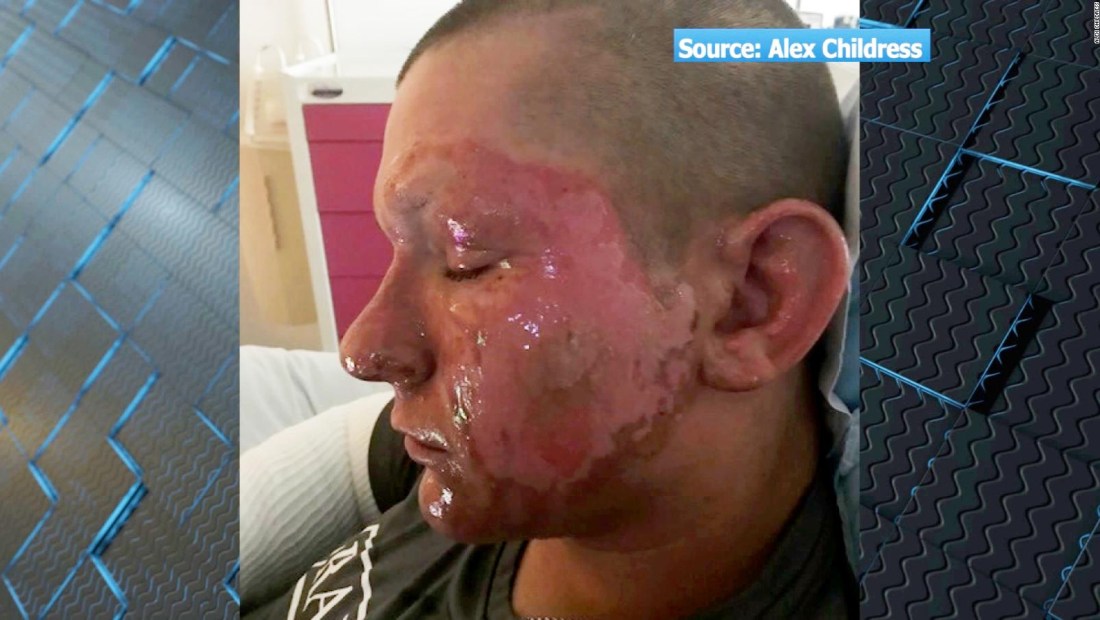 Una planta tóxica quemó la cara a este joven