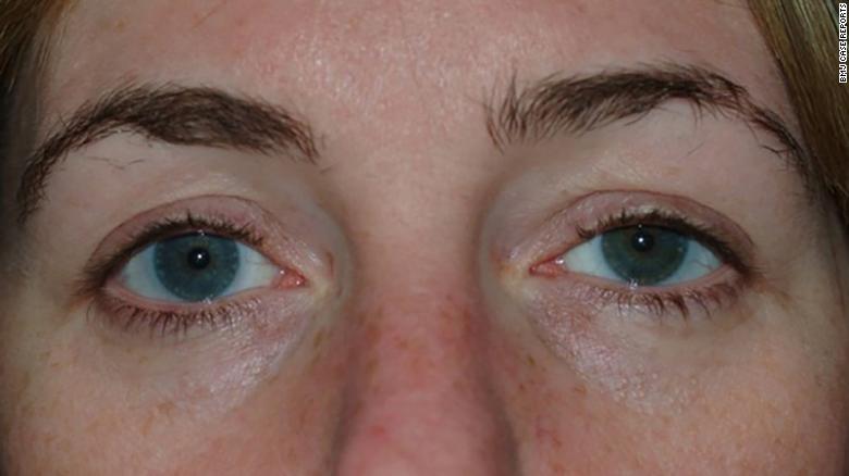 Un leve hinchazón y un poco de caída se puede ver en el ojo izquierdo de la mujer.