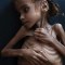 Muere Amal Hussein, símbolo de la hambruna en Yemen