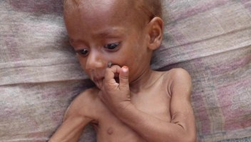 85.000 niños han muerto en Yemen por hambruna