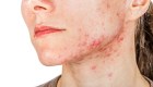 Los mitos y verdades del acné
