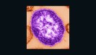 EE.UU.: 90 nuevos casos de sarampión