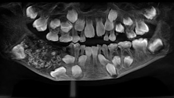 Remueven 526 dientes de la mandíbula de un niño