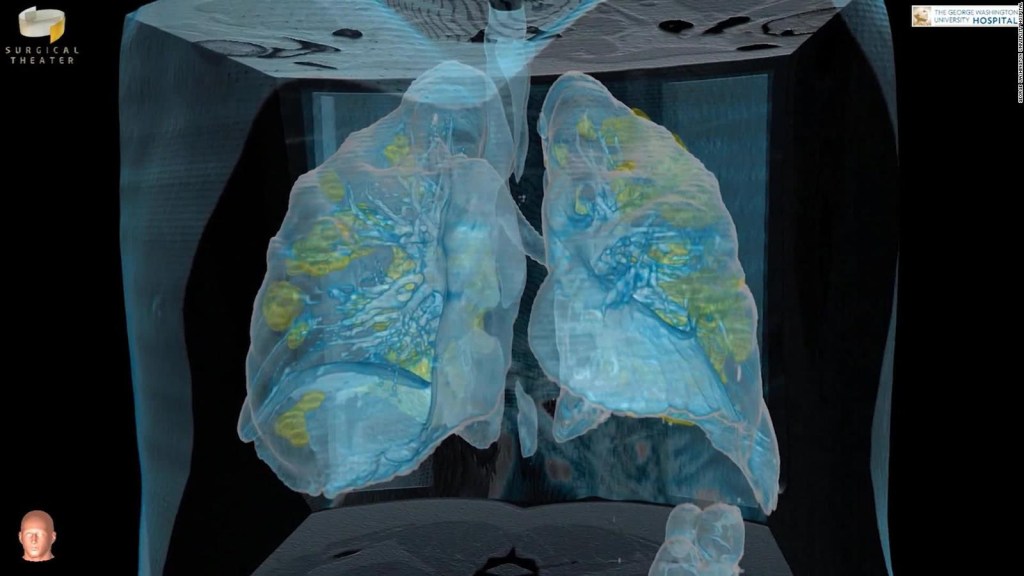 Mira el ataque del covid-19 a los pulmones en 3D