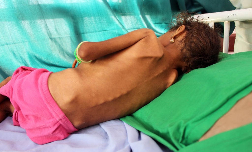 Casi 7 millones de niños más podrían sufrir de desnutrición por la pandemia