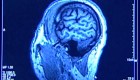 Detectan síntomas de afección cerebral tras covid-19
