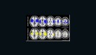 ¿Qué es la degeneración cerebral CTE y qué la produce?
