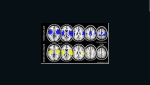¿Qué es la degeneración cerebral CTE y qué la produce?